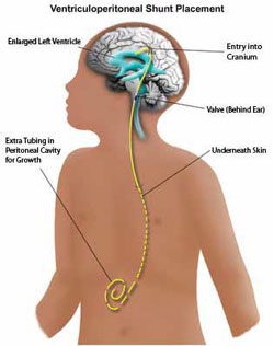 What is a shunt?, Hydrocephalus and Young People